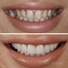 Veneers Turkey Before After 30