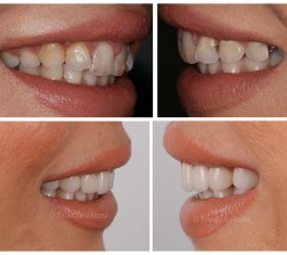 Veneers Turkey Before After 29