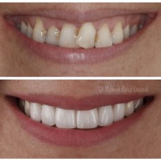 Veneers Turkey Before After 28