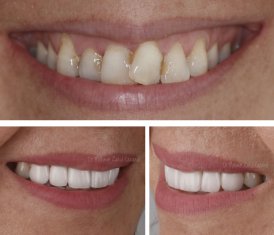 Veneers Turkey Before After 27