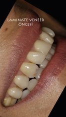 Veneers Turkey Before After 25