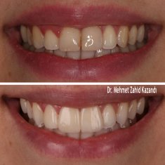 Veneers Turkey Before After 24