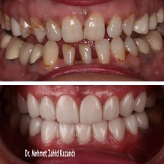 Veneers Turkey Before After 23