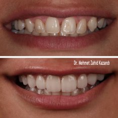 Veneers Turkey Before After 22