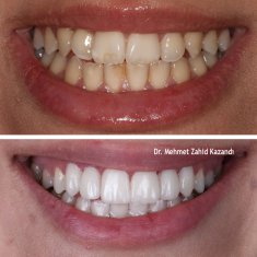 Veneers Turkey Before After 21