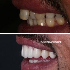 Veneers Turkey Before After 20