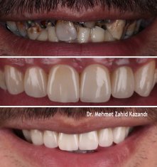 Veneers Turkey Before After 19