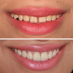 Veneers Turkey Before After 53