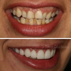 Veneers Turkey Before After 52