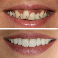 Veneers Turkey Before After 51