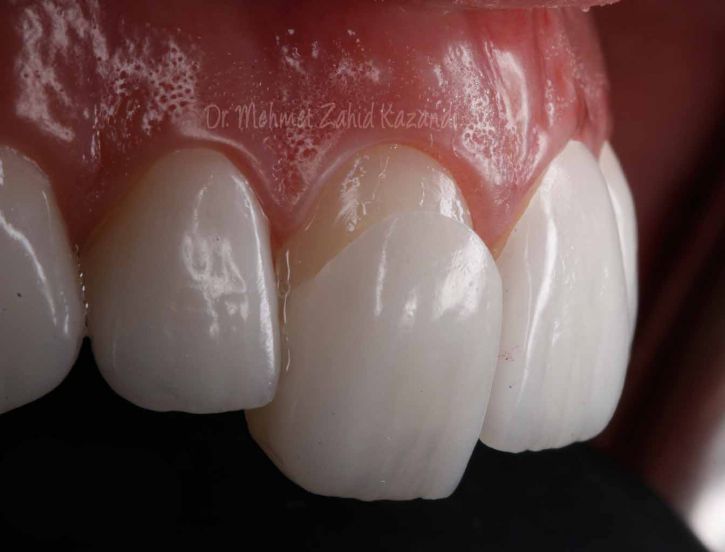 what is porcelain veneer